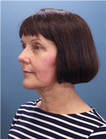 Facelift Before Photo by Marvin Shienbaum, MD; Brandon, FL - Case 34983