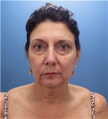 Facelift Before Photo by Marvin Shienbaum, MD; Brandon, FL - Case 34984