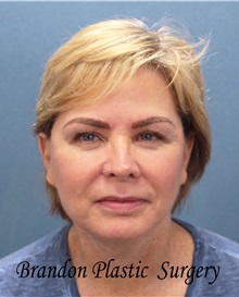 Facelift After Photo by Marvin Shienbaum, MD; Brandon, FL - Case 34985