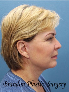 Facelift After Photo by Marvin Shienbaum, MD; Brandon, FL - Case 34985