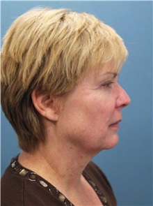 Facelift Before Photo by Marvin Shienbaum, MD; Brandon, FL - Case 34985