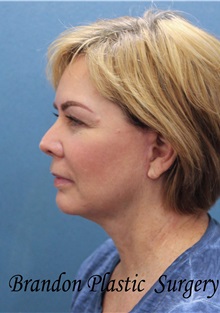 Facelift After Photo by Marvin Shienbaum, MD; Brandon, FL - Case 34985