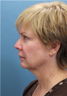 Facelift Before Photo by Marvin Shienbaum, MD; Brandon, FL - Case 34985