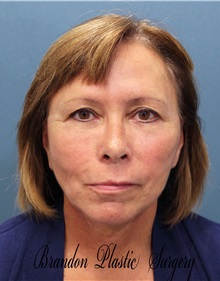 Facelift After Photo by Marvin Shienbaum, MD; Brandon, FL - Case 34986