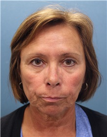 Facelift Before Photo by Marvin Shienbaum, MD; Brandon, FL - Case 34986