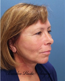 Facelift After Photo by Marvin Shienbaum, MD; Brandon, FL - Case 34986