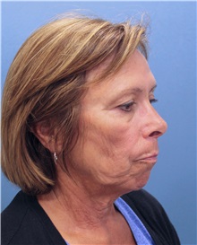 Facelift Before Photo by Marvin Shienbaum, MD; Brandon, FL - Case 34986