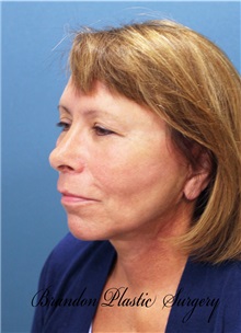 Facelift After Photo by Marvin Shienbaum, MD; Brandon, FL - Case 34986