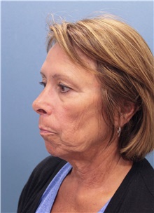 Facelift Before Photo by Marvin Shienbaum, MD; Brandon, FL - Case 34986