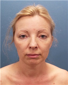 Facelift Before Photo by Marvin Shienbaum, MD; Brandon, FL - Case 34987