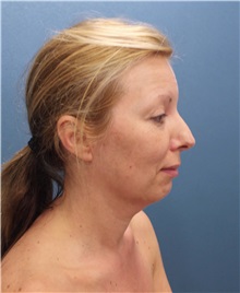 Facelift Before Photo by Marvin Shienbaum, MD; Brandon, FL - Case 34987