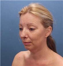 Facelift Before Photo by Marvin Shienbaum, MD; Brandon, FL - Case 34987