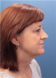 Facelift Before Photo by Marvin Shienbaum, MD; Brandon, FL - Case 34988