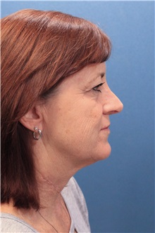 Facelift Before Photo by Marvin Shienbaum, MD; Brandon, FL - Case 34988