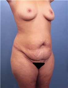 Tummy Tuck Before Photo by Marvin Shienbaum, MD; Brandon, FL - Case 34989