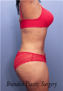 Tummy Tuck After Photo by Marvin Shienbaum, MD; Brandon, FL - Case 34989