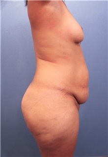 Tummy Tuck Before Photo by Marvin Shienbaum, MD; Brandon, FL - Case 34989