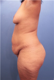 Tummy Tuck Before Photo by Marvin Shienbaum, MD; Brandon, FL - Case 34989