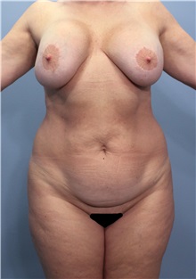 Tummy Tuck Before Photo by Marvin Shienbaum, MD; Brandon, FL - Case 34990