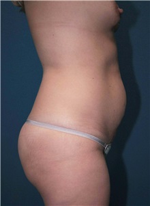 Body Contouring Before Photo by Marvin Shienbaum, MD; Brandon, FL - Case 34991