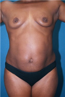 Body Contouring Before Photo by Marvin Shienbaum, MD; Brandon, FL - Case 34992