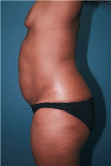 Body Contouring Before Photo by Marvin Shienbaum, MD; Brandon, FL - Case 34992