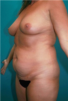 Body Contouring Before Photo by Marvin Shienbaum, MD; Brandon, FL - Case 34995