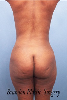 Body Contouring After Photo by Marvin Shienbaum, MD; Brandon, FL - Case 34996