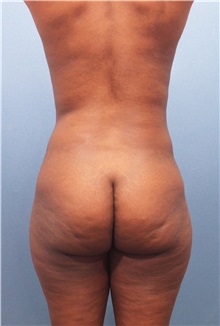 Body Contouring Before Photo by Marvin Shienbaum, MD; Brandon, FL - Case 34996