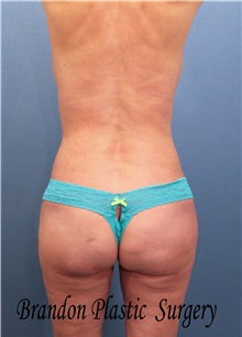 Body Contouring After Photo by Marvin Shienbaum, MD; Brandon, FL - Case 34997