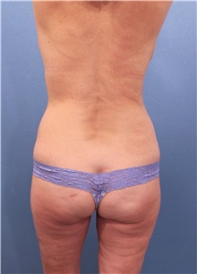 Body Contouring Before Photo by Marvin Shienbaum, MD; Brandon, FL - Case 34997