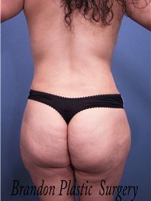 Body Contouring After Photo by Marvin Shienbaum, MD; Brandon, FL - Case 34998