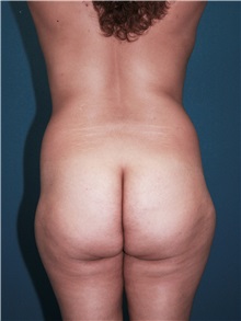 Body Contouring Before Photo by Marvin Shienbaum, MD; Brandon, FL - Case 34998