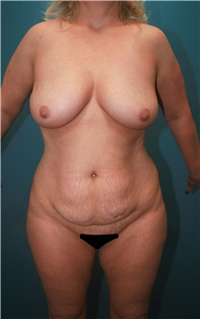 Body Contouring Before Photo by Marvin Shienbaum, MD; Brandon, FL - Case 34999