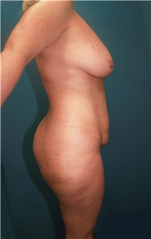 Body Contouring Before Photo by Marvin Shienbaum, MD; Brandon, FL - Case 34999