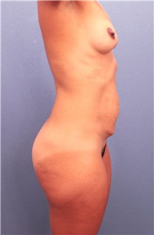 Body Contouring Before Photo by Marvin Shienbaum, MD; Brandon, FL - Case 35004