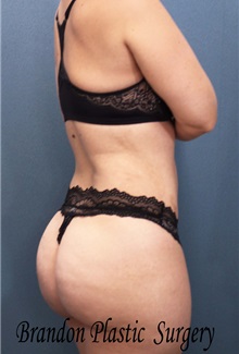 Buttock Lift with Augmentation After Photo by Marvin Shienbaum, MD; Brandon, FL - Case 35005