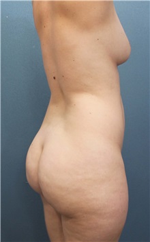 Buttock Lift with Augmentation Before Photo by Marvin Shienbaum, MD; Brandon, FL - Case 35005