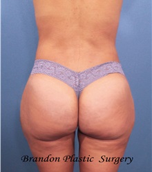 Buttock Lift with Augmentation After Photo by Marvin Shienbaum, MD; Brandon, FL - Case 35006