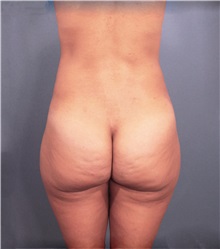 Buttock Lift with Augmentation Before Photo by Marvin Shienbaum, MD; Brandon, FL - Case 35006