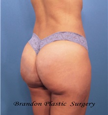 Buttock Lift with Augmentation After Photo by Marvin Shienbaum, MD; Brandon, FL - Case 35006