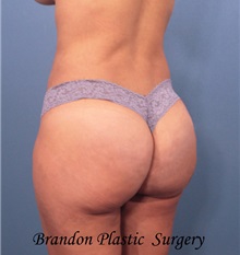 Buttock Lift with Augmentation After Photo by Marvin Shienbaum, MD; Brandon, FL - Case 35006