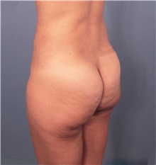 Buttock Lift with Augmentation Before Photo by Marvin Shienbaum, MD; Brandon, FL - Case 35006