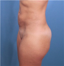 Buttock Lift with Augmentation Before Photo by Marvin Shienbaum, MD; Brandon, FL - Case 35006