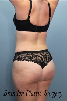 Buttock Lift with Augmentation After Photo by Marvin Shienbaum, MD; Brandon, FL - Case 35009