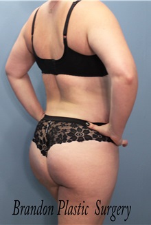 Buttock Lift with Augmentation After Photo by Marvin Shienbaum, MD; Brandon, FL - Case 35009