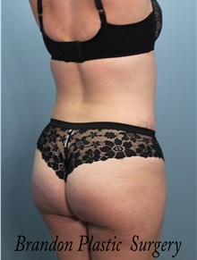 Buttock Lift with Augmentation After Photo by Marvin Shienbaum, MD; Brandon, FL - Case 35009