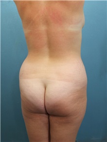 Buttock Lift with Augmentation Before Photo by Marvin Shienbaum, MD; Brandon, FL - Case 35009