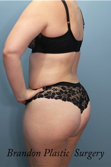 Buttock Lift with Augmentation After Photo by Marvin Shienbaum, MD; Brandon, FL - Case 35009