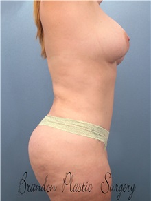 Buttock Lift with Augmentation After Photo by Marvin Shienbaum, MD; Brandon, FL - Case 35011